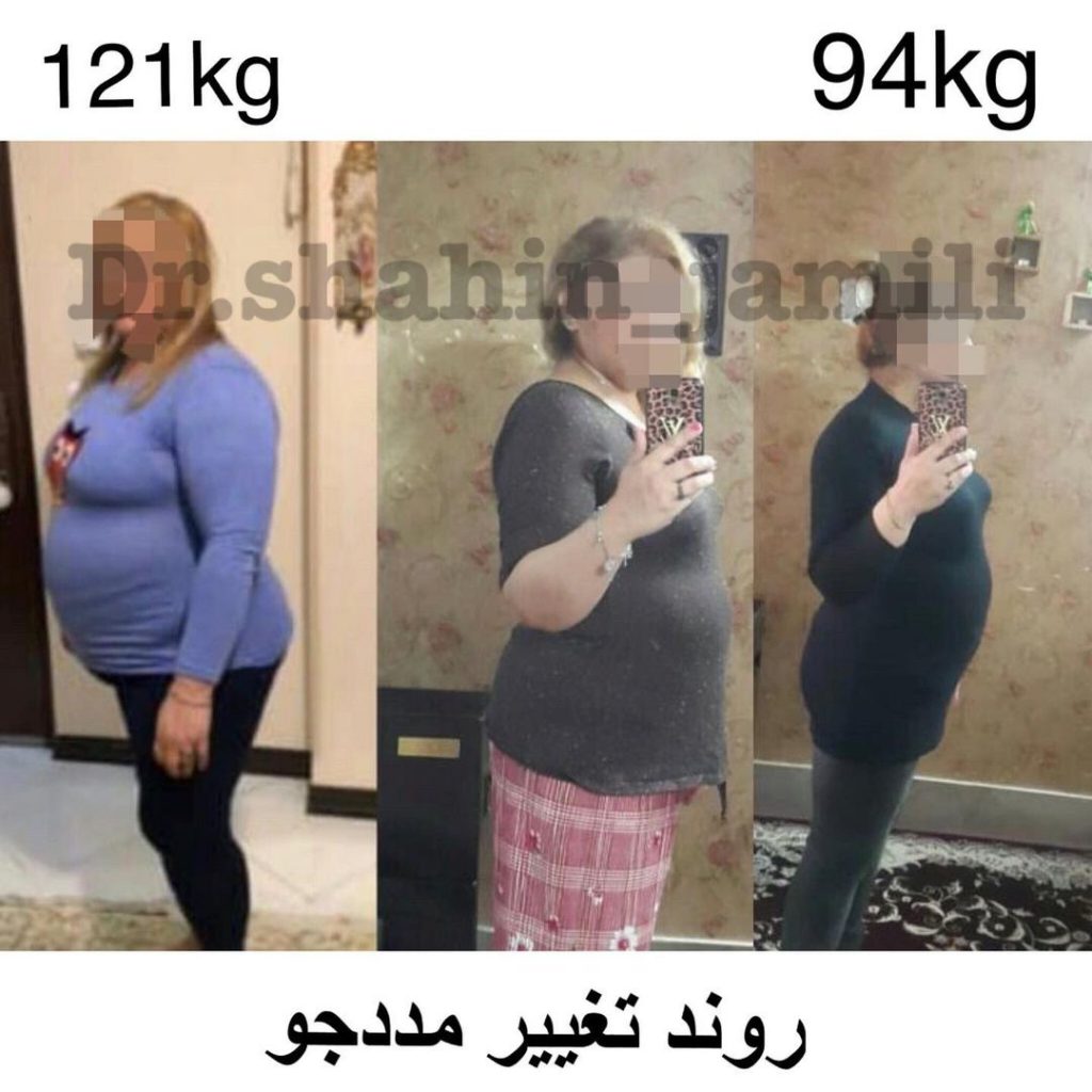قبل و بعد از جراحی چاقی